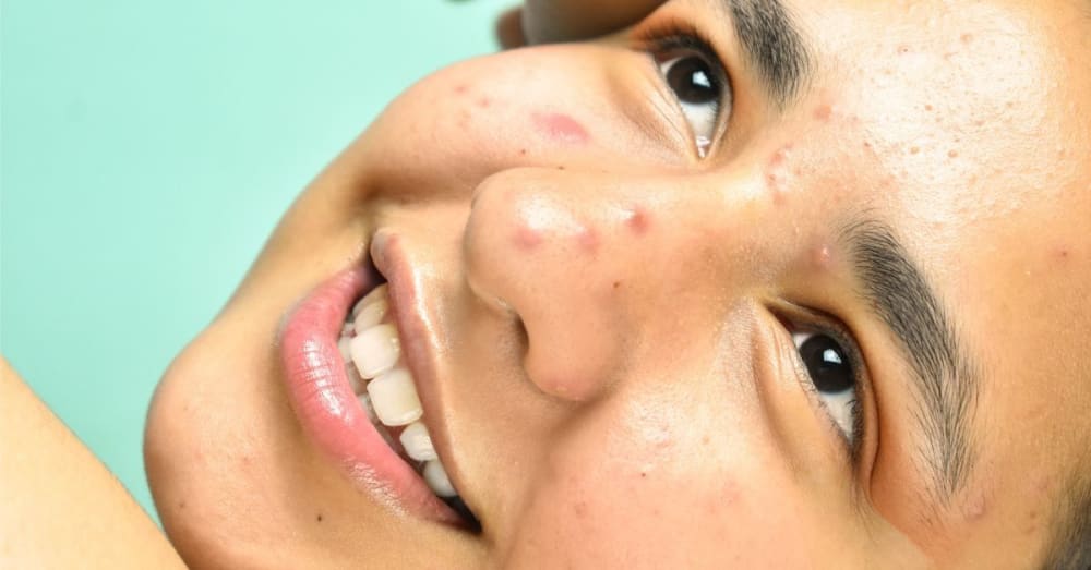 how-you-can-get-rid-of-tiny-bumps-on-face-shortly-besthealthlines